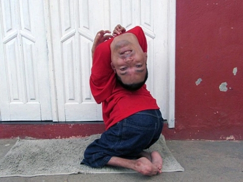 Cực kỳ hiếm gặp: Người đàn ông có đầu lộn ngược